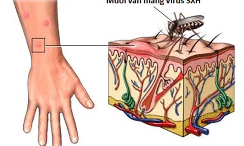 Tây Nguyên: Bốn người tử vong vì sốt xuất huyết 