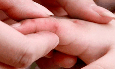 Bệnh tay chân miệng có chiều hướng gia tăng tại Đà Nẵng