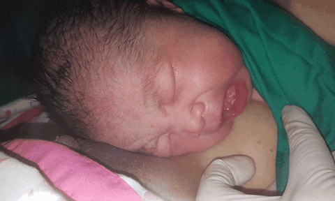 TP.HCM: Hy hữu…bé gái vừa sinh đã mọc nhú răng