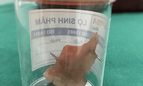 Dự tiệc về nghỉ trưa, nam thanh niên nuốt luôn răng giả 