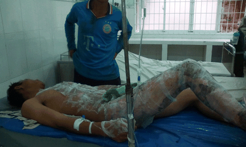 Hy hữu thợ điện thoát chết dù bị điện giật, bỏng nặng 