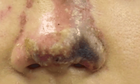 Hoại tử mũi vì tiêm chất làm đầy 