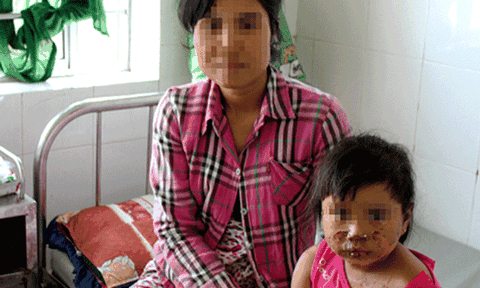 Anh nhóm lửa bằng xăng làm em bị bỏng nặng 