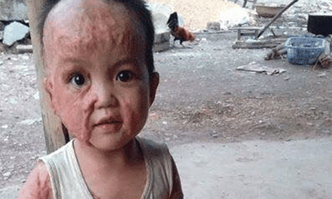 Rơi nước mắt khuôn mặt biến dạng của cháu bé 2 tuổi
