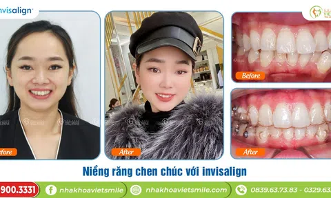 Niềng răng invisalign chỉ điều trị ca đơn giản? Hiểu đúng để chọn đúng