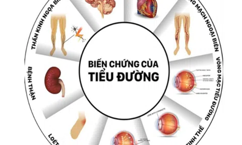 Aiky Sure - dinh dưỡng hỗ trợ tốt cho người bệnh đái tháo đường được đánh giá cao hiện nay
