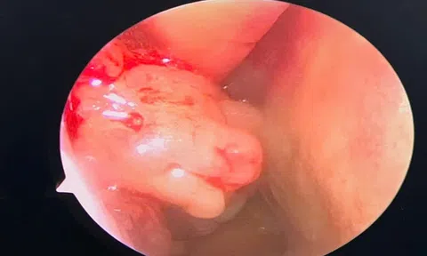 Bệnh viện Đa khoa Thanh Chương đã thực hiện thành công ca phẫu thuật nội soi viêm đa xoang có polyp mũi