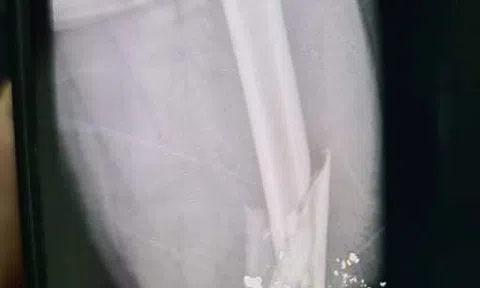 Hà Tĩnh: Mâu thuẫn trong buổi nhậu, người đàn ông bị bắn gãy xương đùi