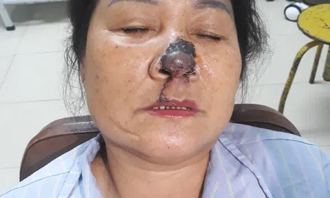 Nghệ An: Tái tạo thành công trụ mũi cho bệnh nhân bị chém đứt lìa