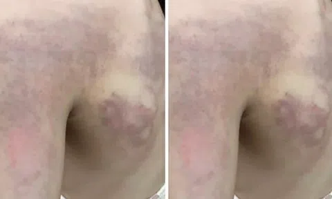 Nghệ An: Tạm đình chỉ dạy học với cô giáo đánh học sinh lớp 3 bầm tím lưng