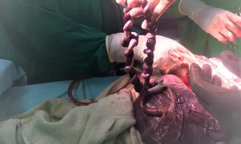 Bệnh viện Hoàn Mỹ Đà Nẵng cứu sống mẹ và thai nhi non tháng, IVF có dây rốn xoắn, thắt nút phức tạp
