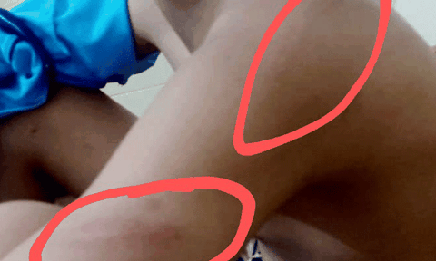 Hà Tĩnh: Một cháu bé bị công an viên dùng cây keo quất bầm tím